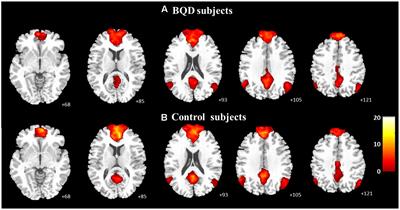 Disrupted Resting-State Default Mode Network in Betel Quid-Dependent Individuals